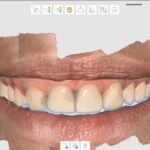 Complete scann + FACE + digital wax-up