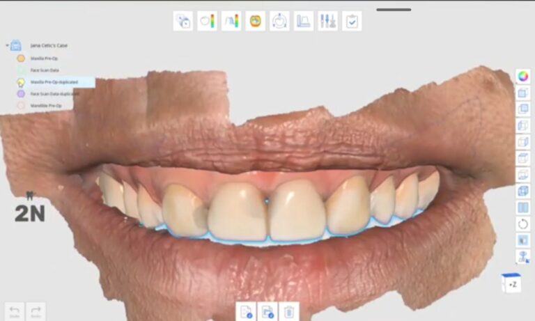Complete scann + FACE + digital wax-up